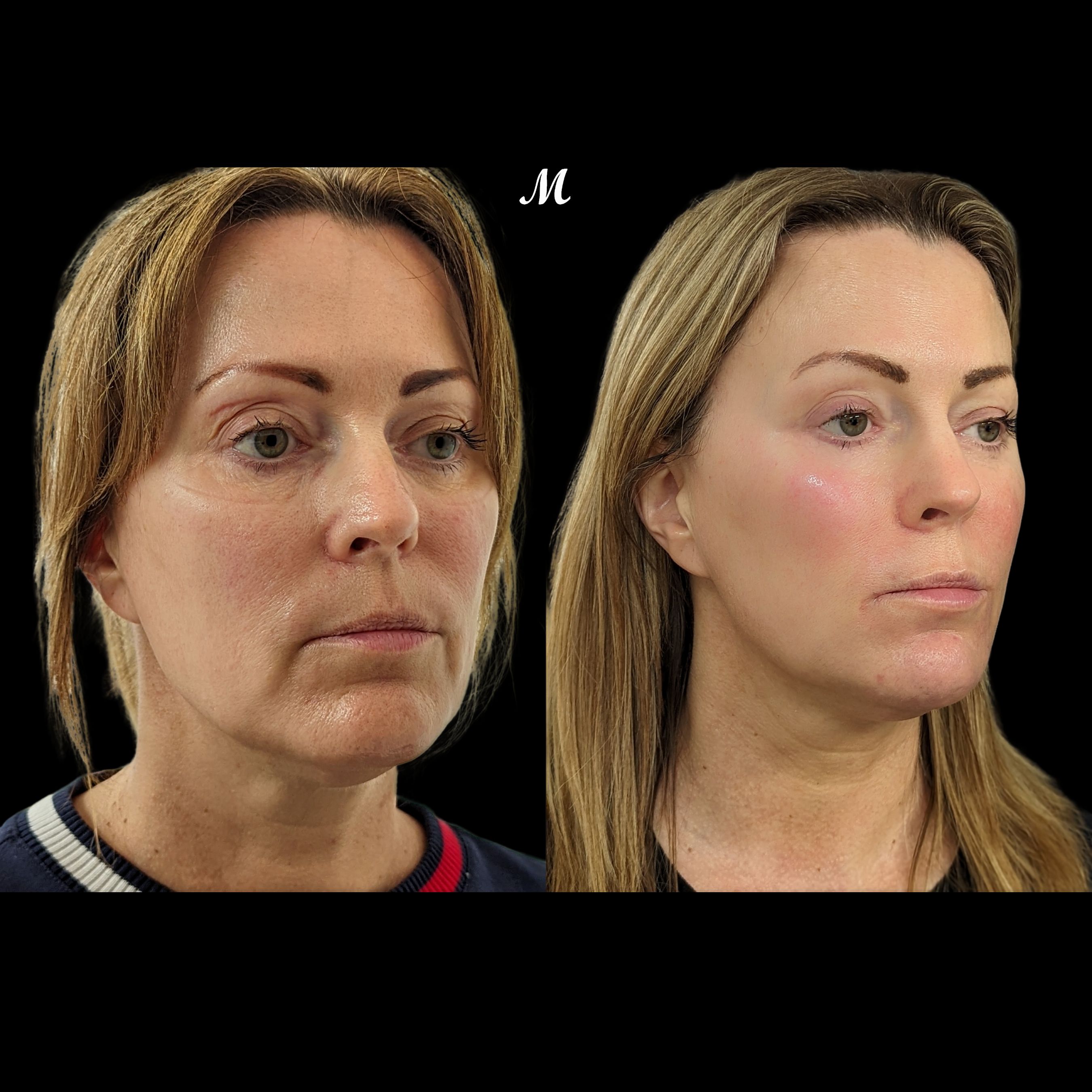 Liquid Lift